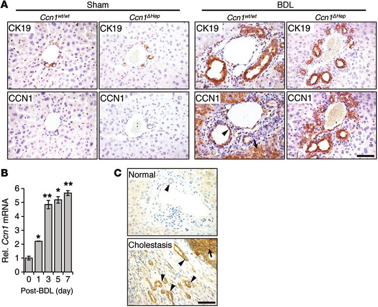 Figure 1. CCN1 is highly elevated in cholangiocytes in human and murine cholestatic livers.