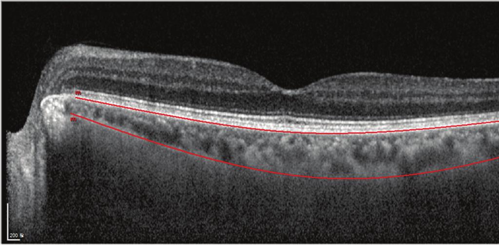 For choroidal volume measurement, we manually moved the automatically segmented internal limiting membrane line to the retinal pigment epithelium and the automatically segmented retinal pigment