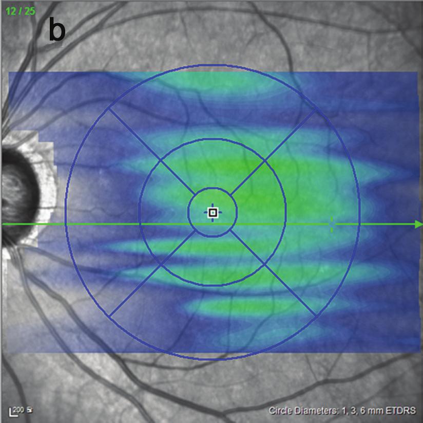 (2) increased retinal arteriovenous transit time; and (3) late retinal artery staining and definite stenosis of carotid artery in carotid doppler examination [11, 12].