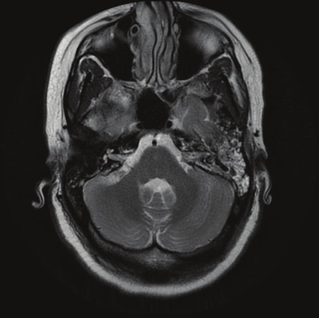 2 Case Reports in Medicine Figure 1: MRI of brain with contrast demonstrating fluid and enhancement within the mastoids, more extensive on the left, suggestive of mastoiditis.