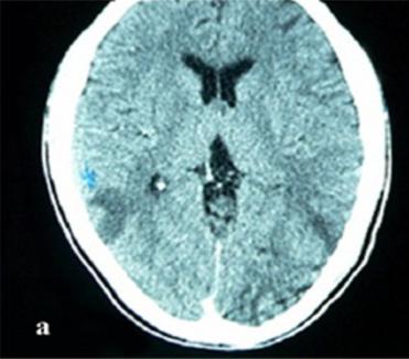 However, all were reported in Caucasian thus making the present case unique in sense that it is the ever first primary intratesticular leiomyosarcoma in African black race.