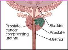 Prostate Cancer Common in men older than 50; ranks high as