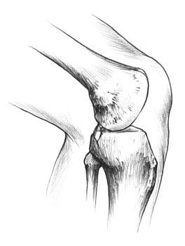 Portal Placement Arthroscopy is initiated through anterolateral and anteromedial portals.