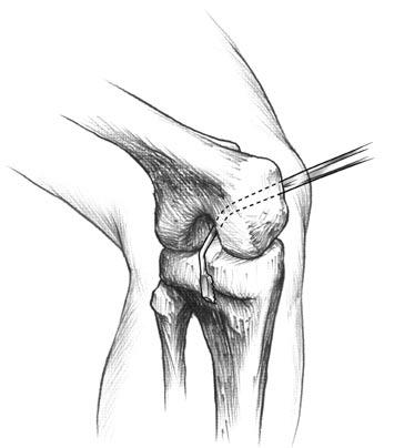 Figure 3 Figure 4 Figure 5 Tibial Tunnel Preparation It is important to be able to visualize the tibial insertion of the posterior cruciate ligament down to the inferior insertion of the posterior
