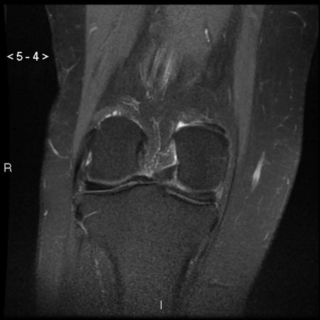 Fig.: Discoid lateral meniscus (coronal