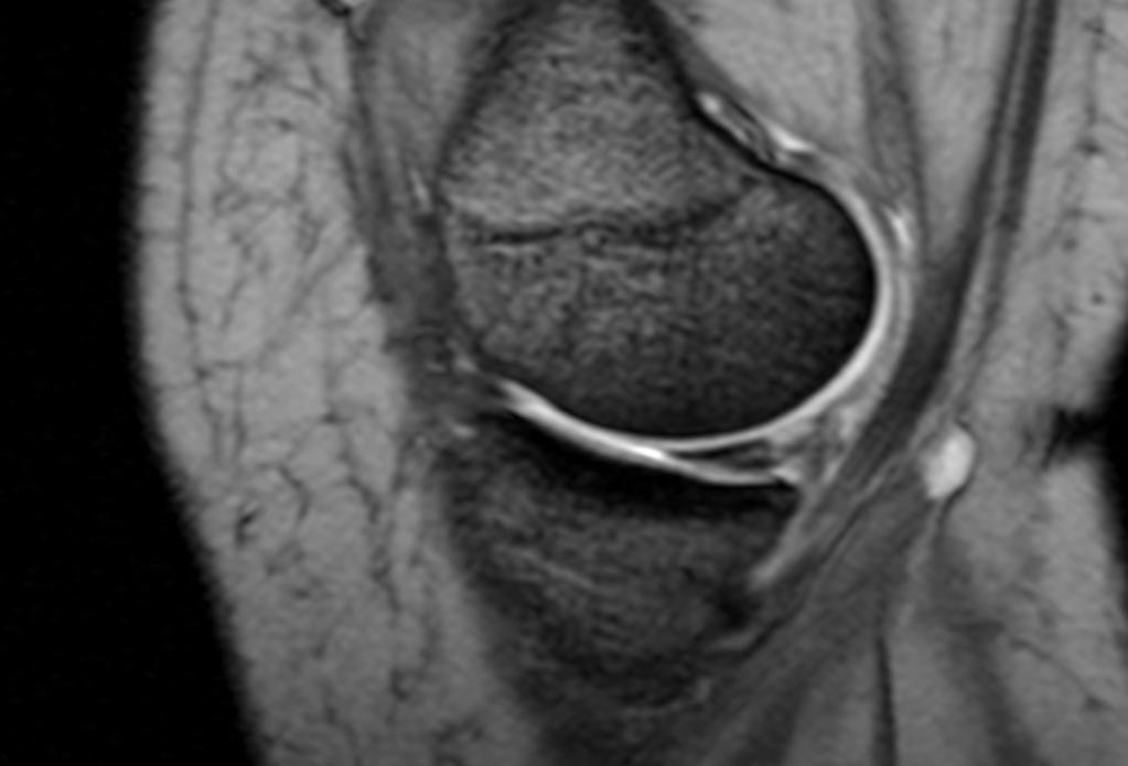 Fig.: Horizontal tear at the posterior horn of the