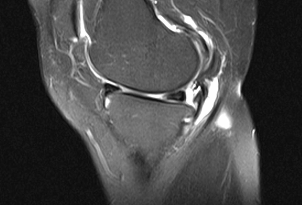 Fig.: Horizontal meniscal tear at the posterior horn, with extension to the body shown by the