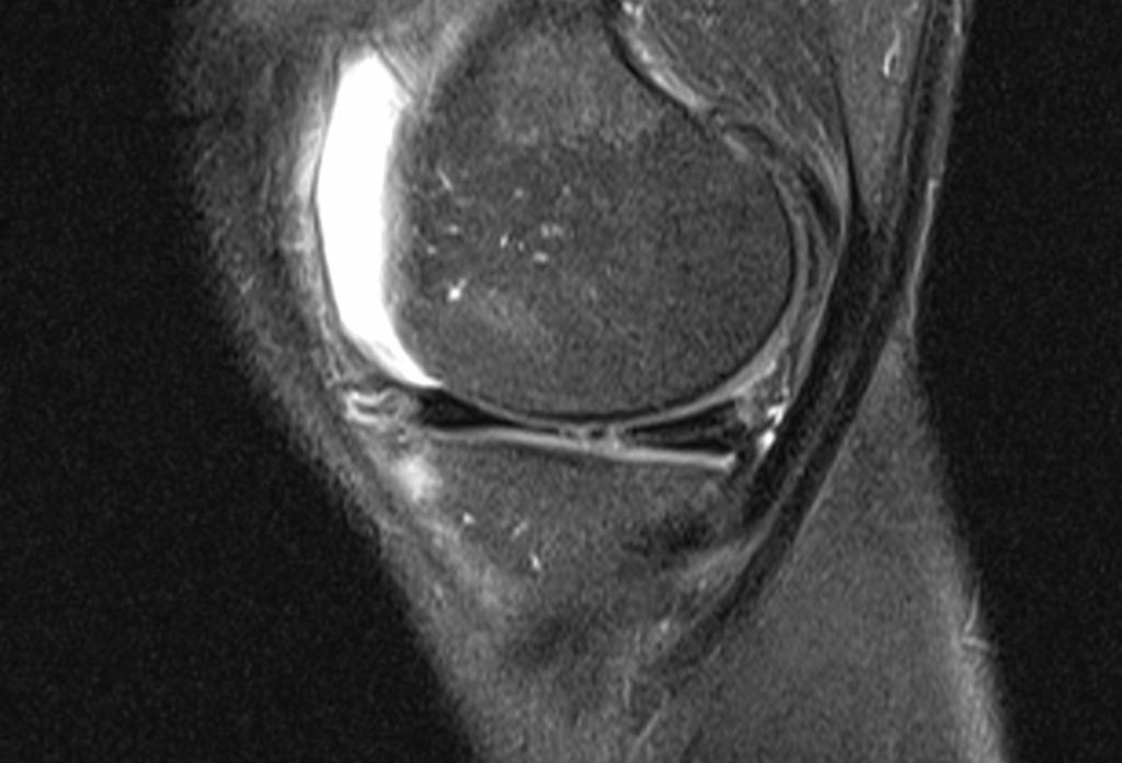 Fig.: Oblique horizontal tear of the posterior horn of the MM, in the same patient, with