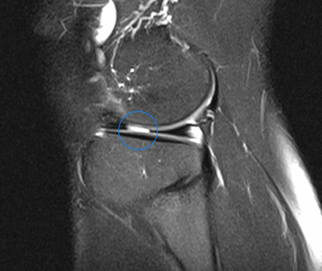 Fig.: The truncated meniscal appearance indicates tear of the body in this lateral meniscus (sagittal fat-saturated proton density-weighted image).