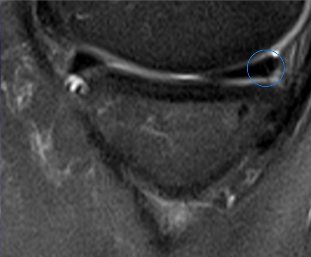 Fig.: Longitudinal vertical tear at the posterior horn of the medial meniscus (sagittal fat-saturated T2-weighted image ).