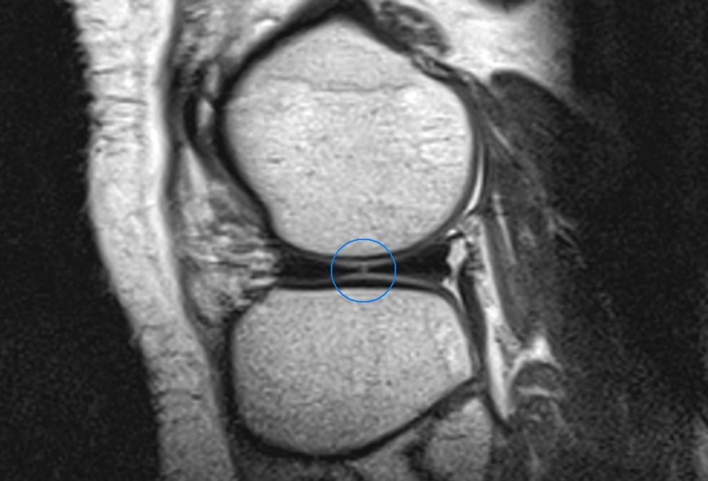 Fig.: Vertical radial tear of the lateral meniscus (sagital proton density-weighted image).