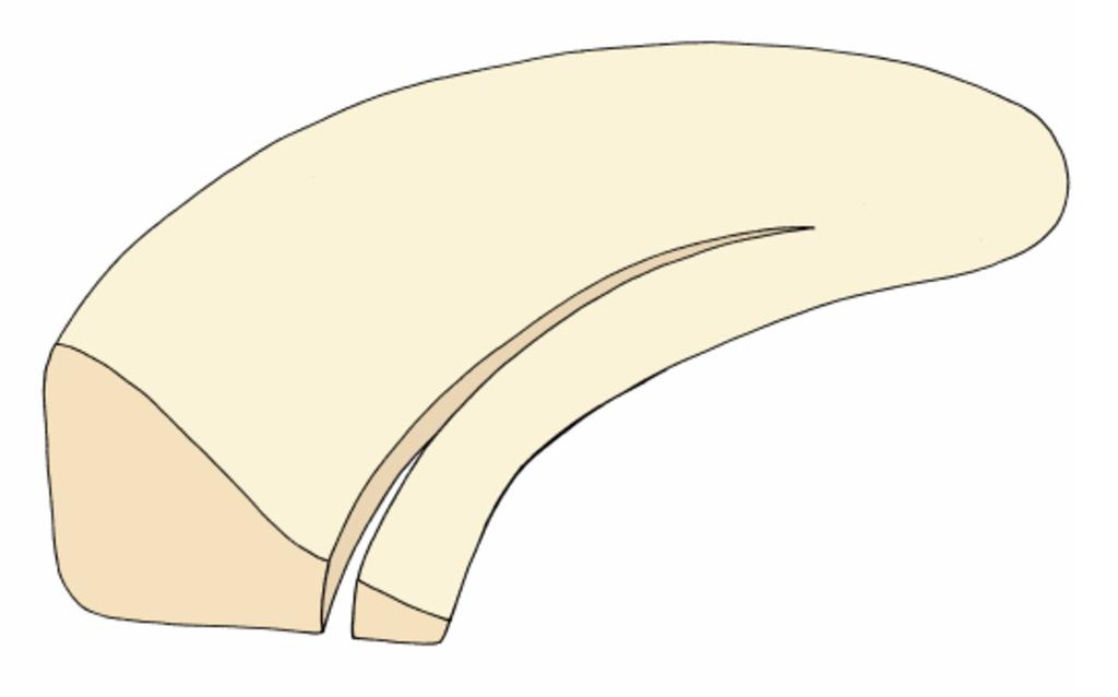 Fig.: The inner meniscal segment of a longitudinal or oblique