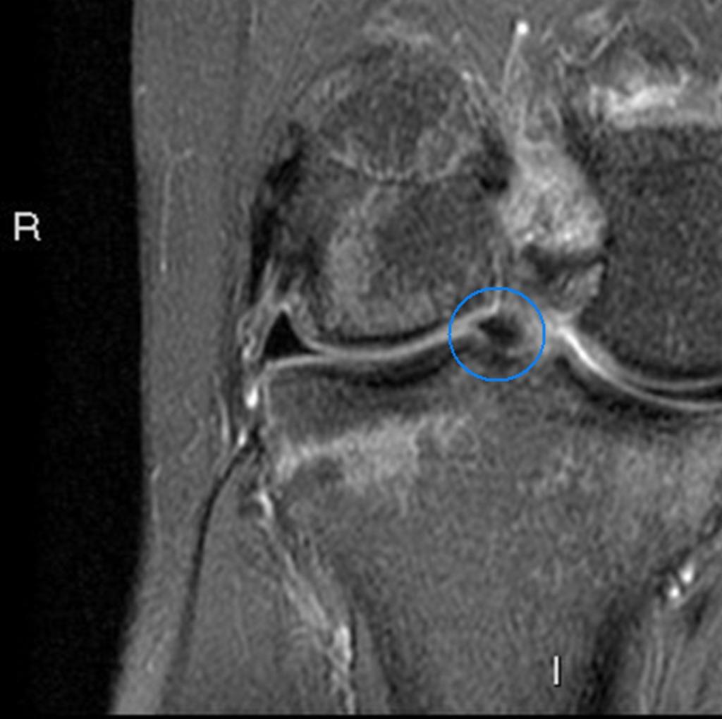 Fig.: Bucket-handle tear of the posterior horn of the LM with internal displacement of the meniscal fragment near the notch.