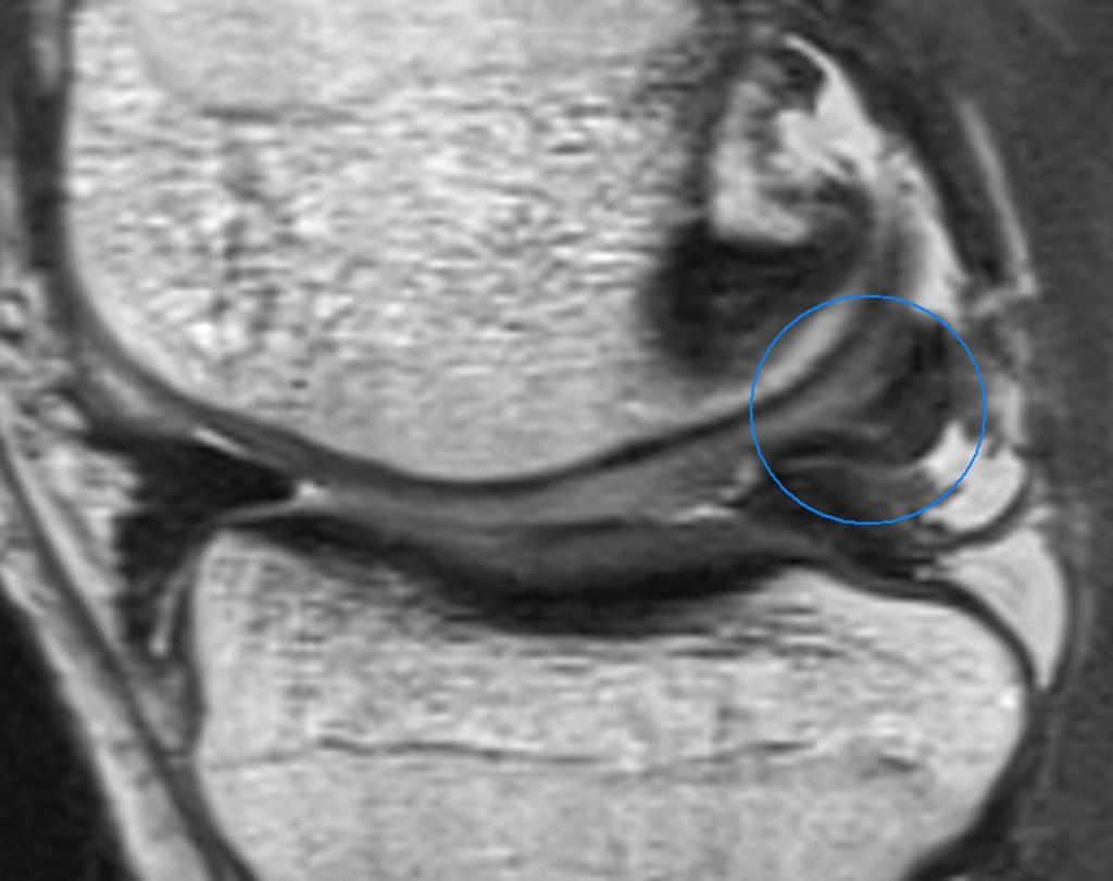 Fig.: Bucket-handle tear - the meniscal fragment is displaced