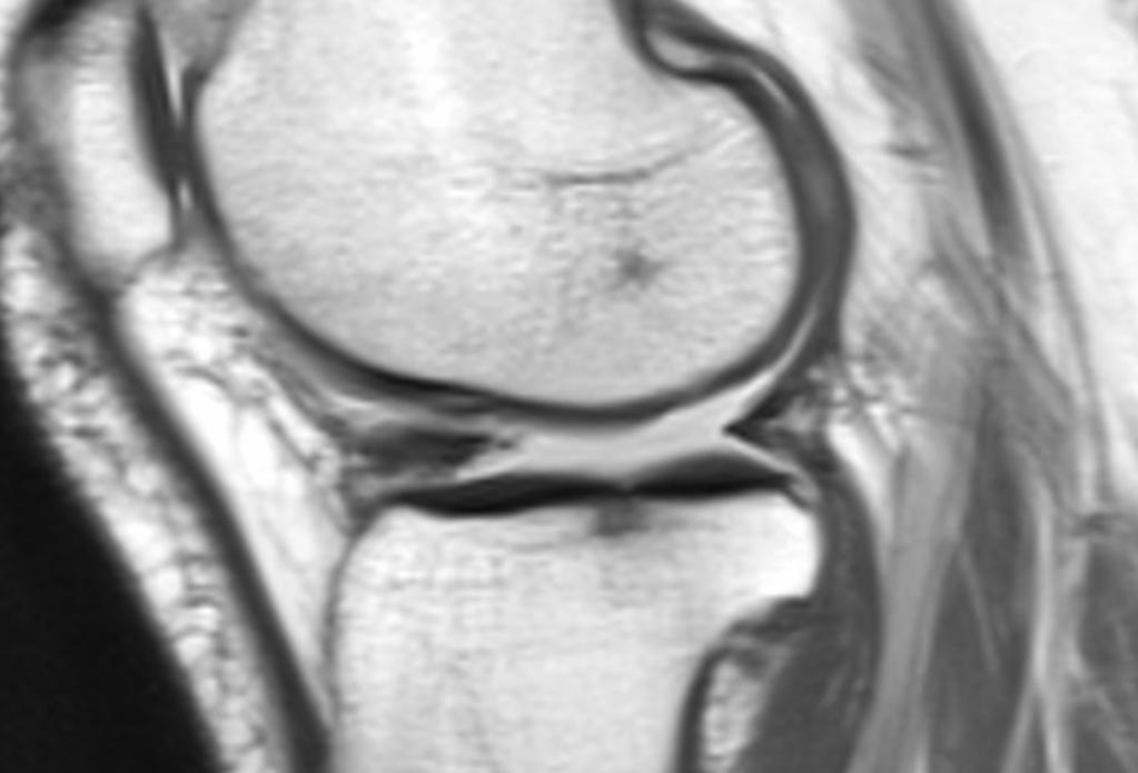 Fig.: Small posterior horn as a sign of displacement of meniscal tissue - bucket-handle tear (sagittal proton density-weighted image).