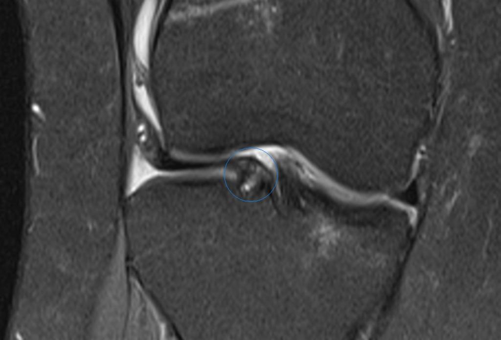 Root tears Occurs at the tibial attachment or "root" of the meniscus, like a full thickness radial tear at or adjacent to the root. It has been described only posteriorly.