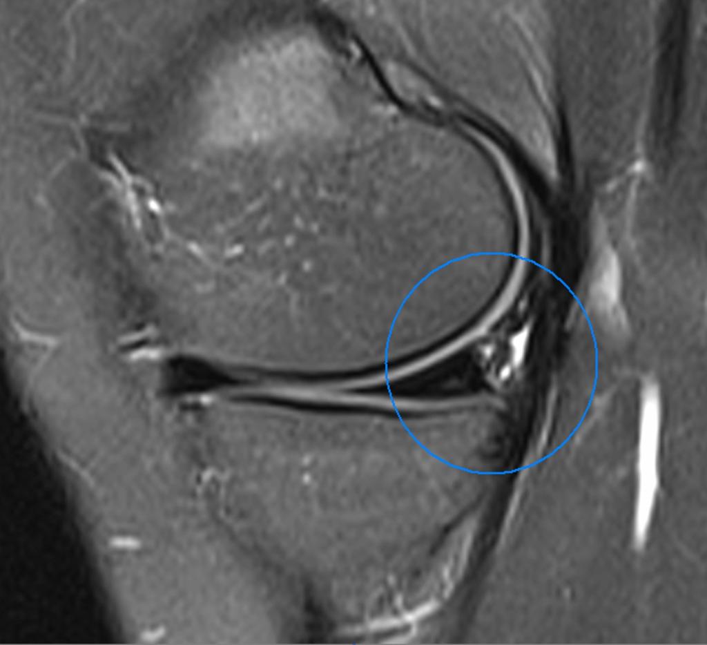 Fig.: Peripheral meniscal vascularization in an adolescent patient (sagittal fatsaturated proton density-weighted image).