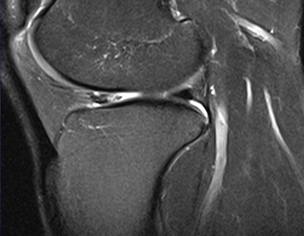 Fig.: Grade 4 - Complex tear at the anterior horn of the lateral meniscus (sagittal fatsaturated