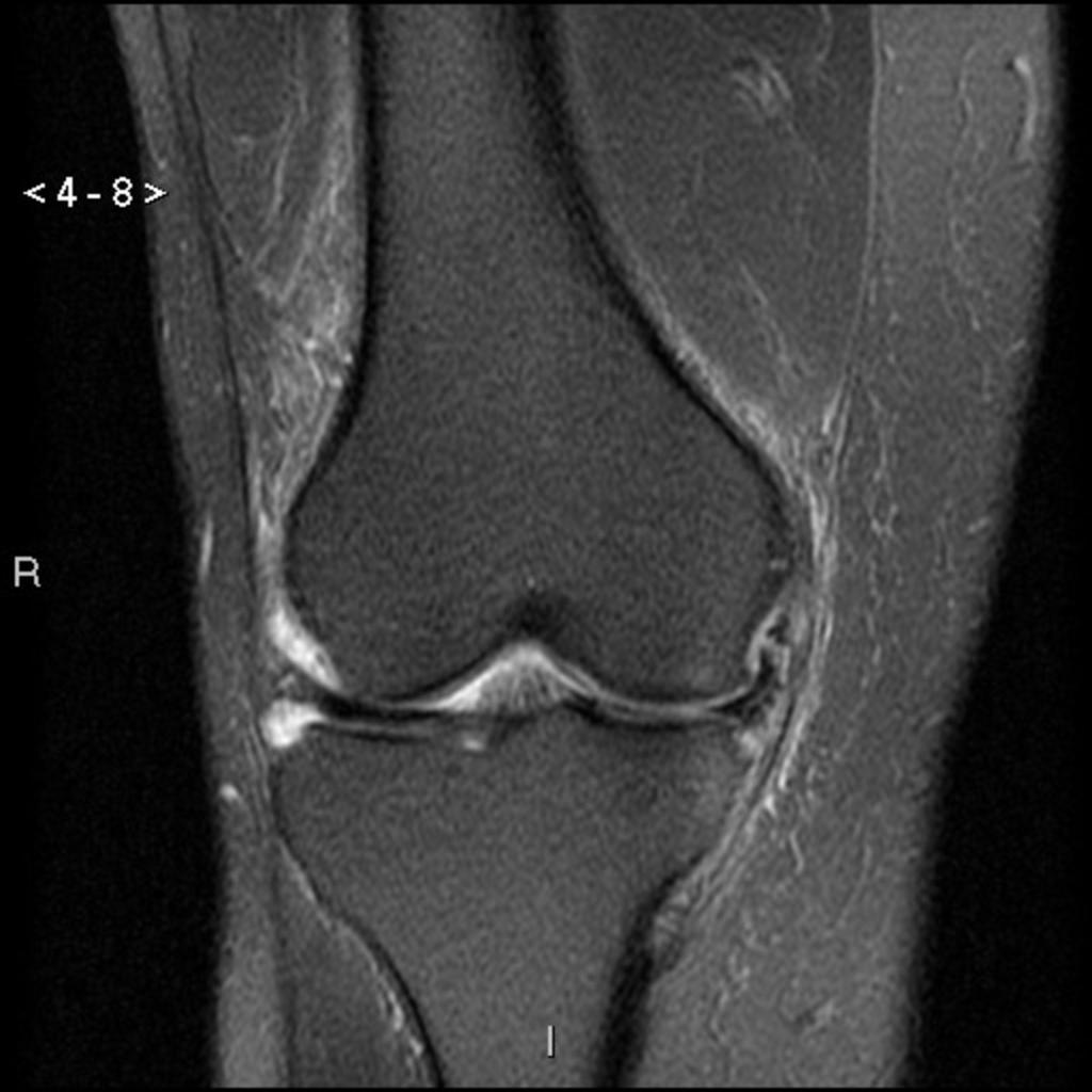 Fig.: Associated lesion of the MCL (coronal