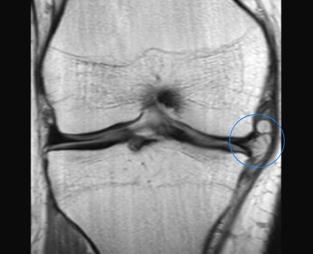 Fig.: Meniscal cyst of the medial meniscus