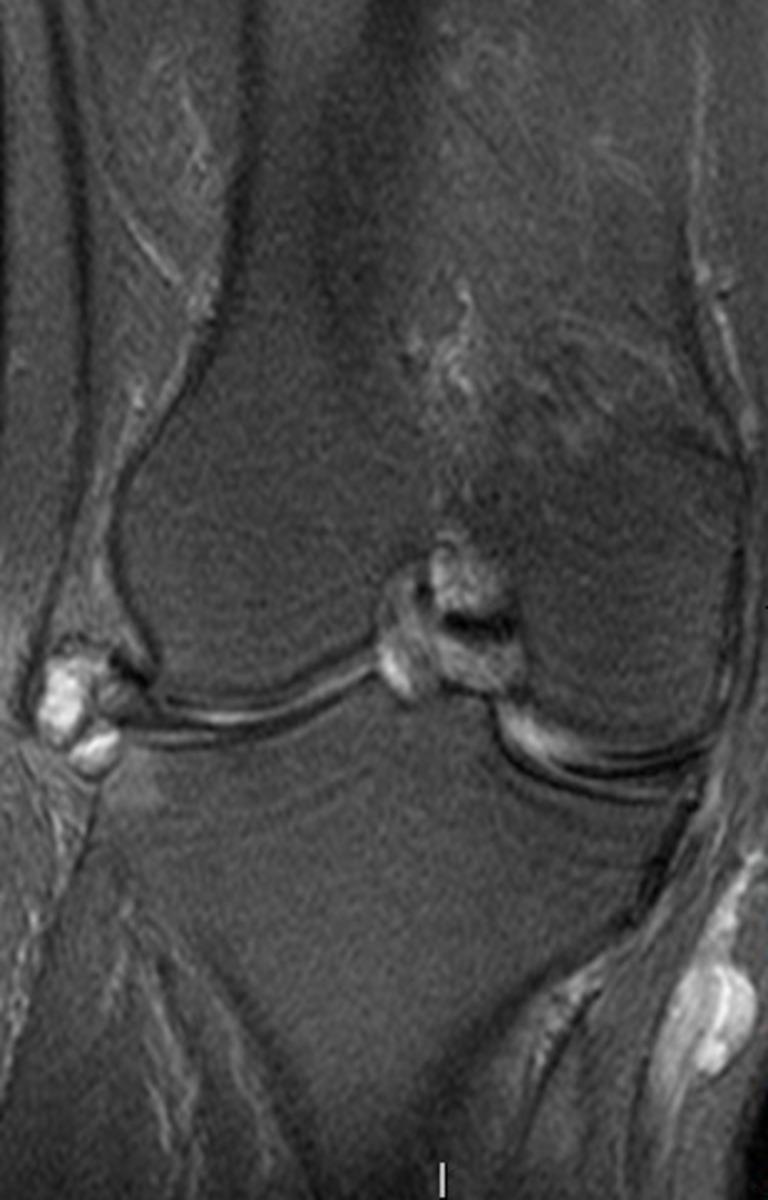 Fig.: Meniscal cyst of the medial meniscus (coronal fat-saturated proton densityweighted image).