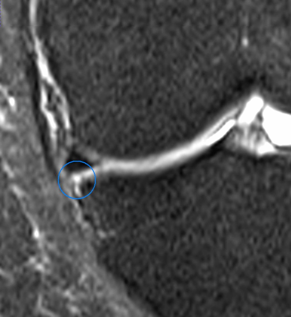 Fig.: Rupture of the coronary ligament (coronal fat-saturated T2-weighted image).