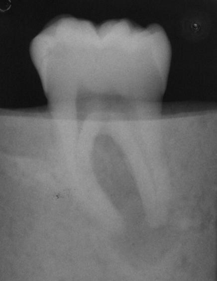 perforations and weakening of tooth structure