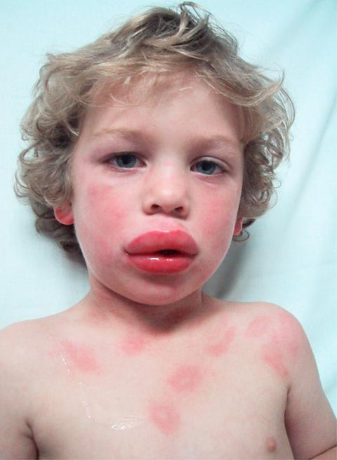 What is Anaphylaxis? * Anaphylaxis is the life threatening form of an allergic reaction.