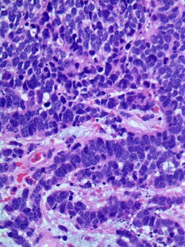 Pure Small Cell Carcinoma