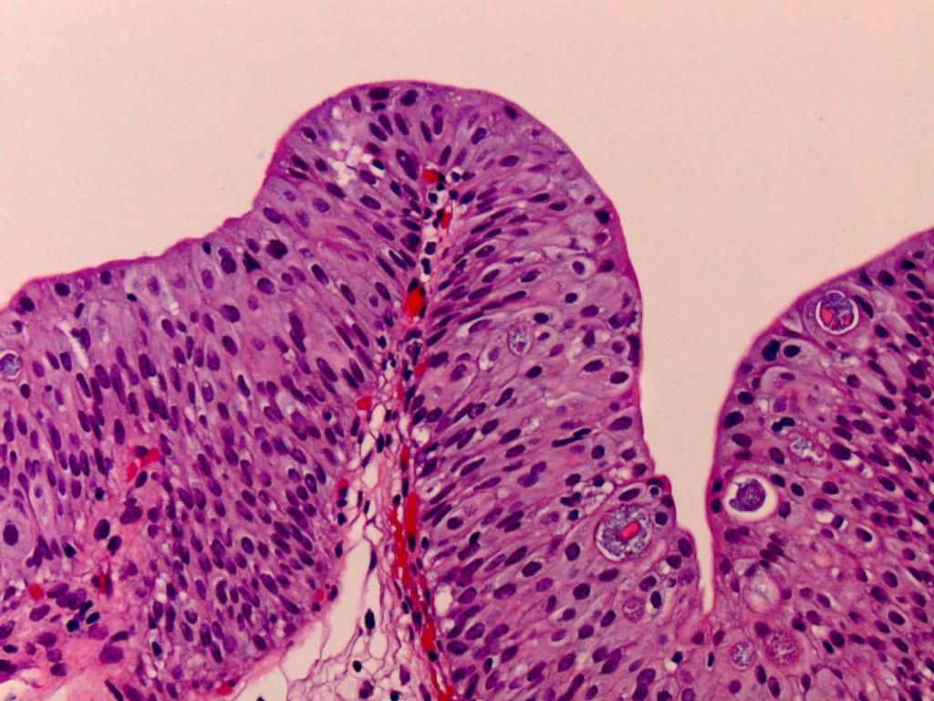 narrow fibrovascular papillary folds cores, of