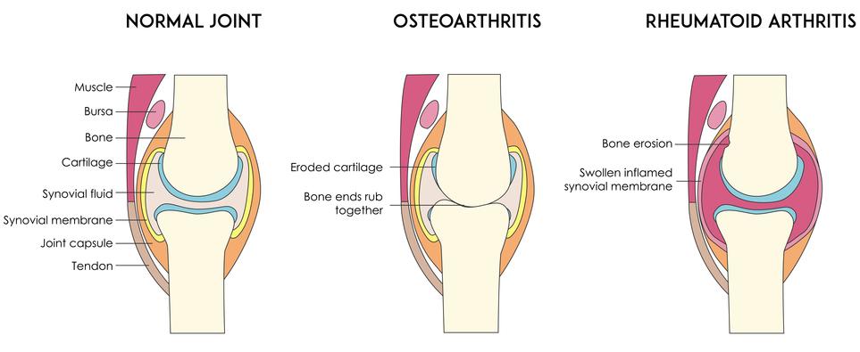 Arthritis - Types Osteo Arthritis - caused by a reduction in the normal amount of cartilage tissue as a result of wear and tear, injury or infection.