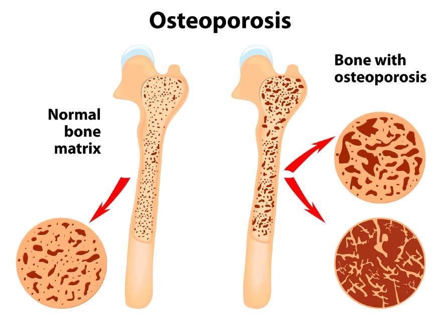 Osteoporosis Osteoporosis is a progressive bone disease that reduces bone density, weakening bone structure and increasing the incidence of bone