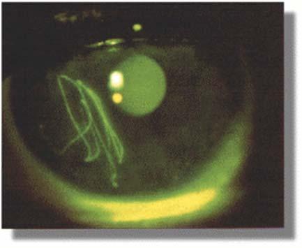 Case #1 Corneal Abrasions Probably the more common eye injury visit to the ED Usually present with
