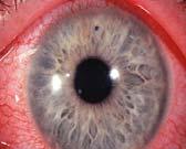 Case #2 Conjunctival/Corneal FB Usually presentation is similar as abrasions Important to evert the