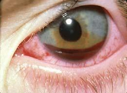 Case #4 Hyphemas Blood in the Anterior Chamber Mechanism of injury usually blunt,