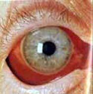 staining, Optic Atrophy, Anterior/Posterior Synechiae Hyphemas Subconjunctival