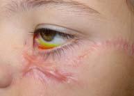 Early primary surgical repair Decontamination of wound Eyelid danger zones 1, 2, and 3 Avoidance of devitalization Children: 4x more likely to be