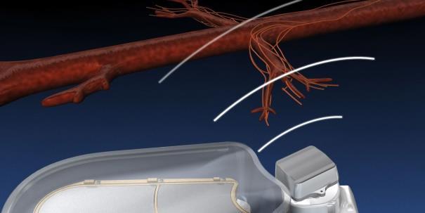 identify renal artery External