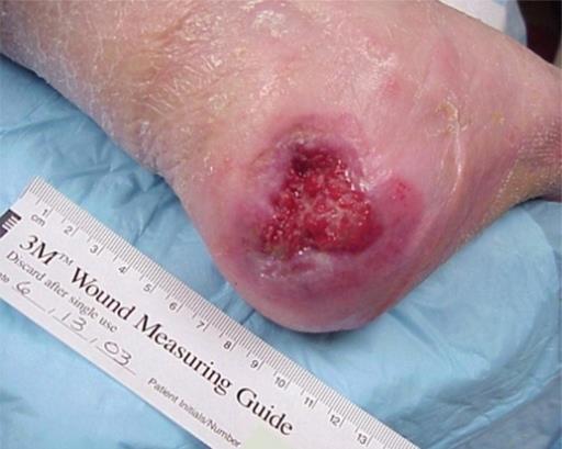 wound healing Maturation Phase of Wound Healing From day 21 until 1 or 2