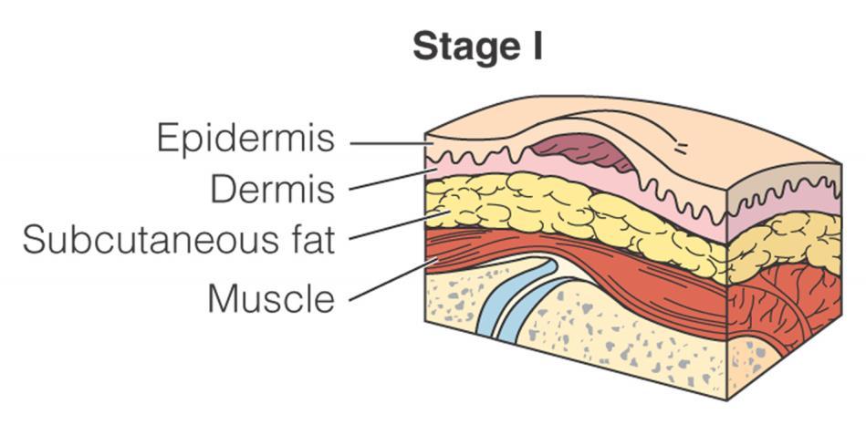 Stages of Pressure Ulcers Stage I: Nonblanchable Erythema of Intact Skin
