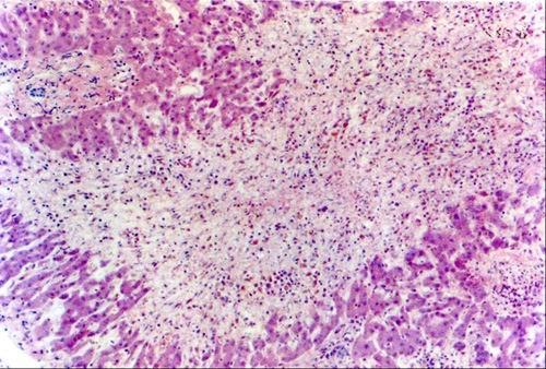 2 Glandular epithelial cells regeneration liver Submassive necrosis