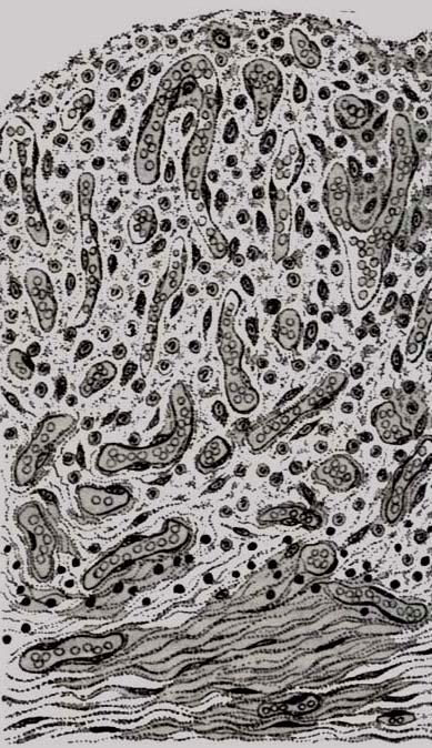 Granulation tissue LM: fibroblasts,