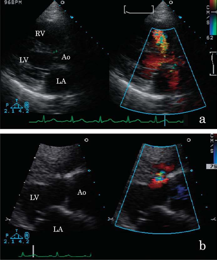 Non cyanotic heart disease: L R shunts Left to right shunts (ASD, VSD, PFO, and PDA) are sometimes diagnosed during pregnancy due to loud heart murmur from increased shunt volume caused by increased