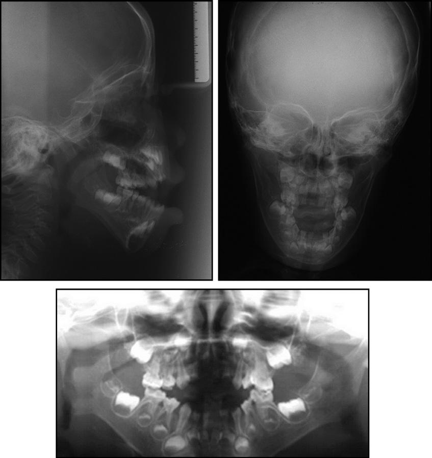 Chung et al 629 Fig 3. Cephalometric and panoramic radiographs, age 3 years 5 months. Fig 4.