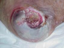 The bridge of the nose, ear, occiput and malleolus do not have subcutaneous tissue and these ulcers can be shallow.