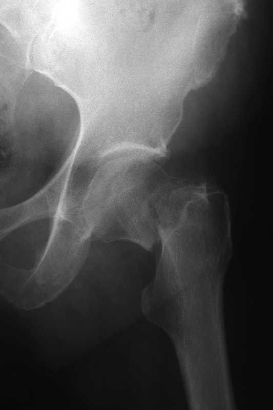 Hip fracture patients arising from osteoporosis have