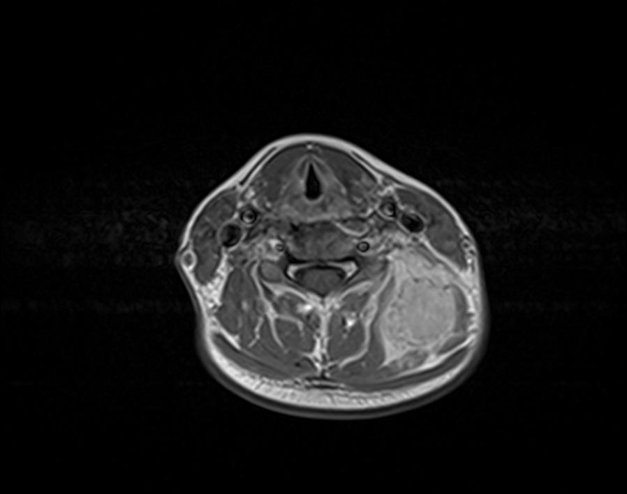 Pol J Radiol, 2014; 79: 228-232 Figure 3. Axial, T1-weighted image reveals hyperintense SI of the lesion with a low-si rim. Figure 5.