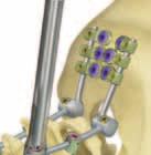 occipital implants and instruments are different in