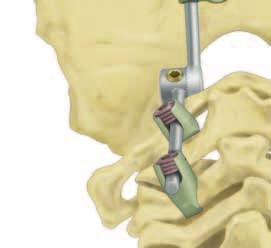 62). Occipital screw connectors Figure 62 The 