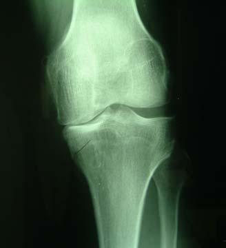 Osteoarthritis of the Knee Medial OA Osteoarthritis often causes X-ray of an arthritic knee deformity and bowing of the legs Note the lack of joint space on. the medial side.